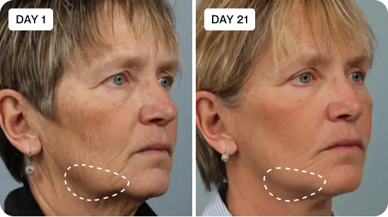 Before and after - Clara