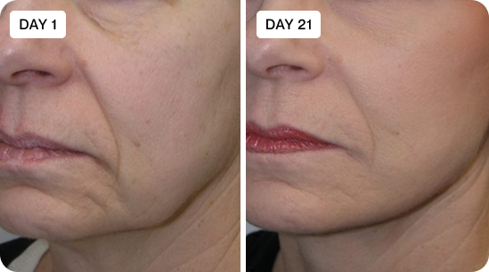 Before and after - Cora