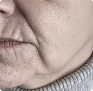 Jowls