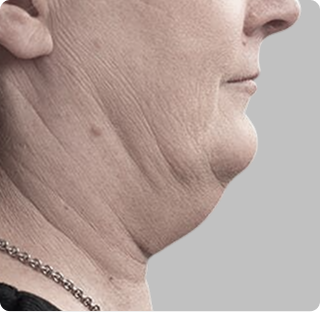 Double Chin